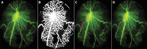 Figure 3. Method of assessment of retinal vascular features.(a) Fluorescein angiogram (FA) of OIR Mouse. (b) Retinal avascular area – calculated from the binary image generated from the FA image as the area of black space as a percentage of total retinal image. (c) Retinal artery tortuousity (RAT) – calculated by selecting branch points along the most tortuous artery using a cursor, from the base of the optic nerve up to a validated distance of 275 ± 25 μm for OIR mice. A linear projection was automatically projected by the software program to connect the first and last points. RAT index is calculated as the ratio of actual vessel length to the projected linear length. RAT of 1 is a non-tortuous vessel, while an RAT index more than 1 denotes degree of arterial tortuosity. (d) Retinal vein width (RVW) – calculated using semi-automated calibrations between two points aligned horizontally at either edge of the largest vein in the FA image starting from the optic nerve base to a pre-validated distance of 275 ± 25 μm. The customized MATLAB program is available at www.quantbv.com.