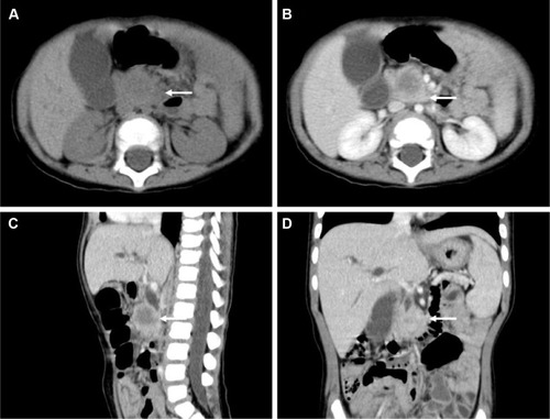 Figure 1 Abdominal computed tomography findings.