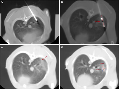 Figure 2. CT-guided lung microwave ablation and tract embolization in the right lower lobe. (A) A 15-G coaxial needle was introduced into the lung tissue ∼10 mm of the pleural surface under CT guidance. (B) Placement of the MW antenna. (C) Removal of the coaxial needle and sealing of the needle tract with gelatin sponge particle suspension (arrow). (D) CT performed 2 weeks after the procedure shows complete absorption of the gelatin sponge particles. The ablation zone is visible (arrowhead).