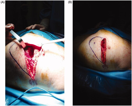 Figure 1. (A) The defect after debridement. (B) Flap design. The blue dot marks the perforator identified with the handled doppler probe.