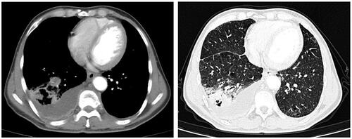 Figure 1 Chest CT at the time of the diagnosis.