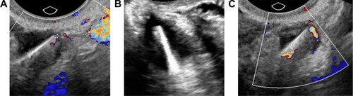 Figure 2 Ultrasound imaging of the IUD.