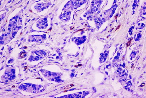 Figure 5.  Immunohistochemical staining for endothelial cells with CD34, representative example of microvessel density (MVD) grade.