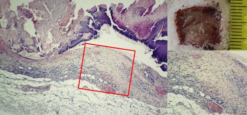 Figure 3 The wound crater center by the end of the 3rd day after wound modeling, Collagen group. Moderately present tissue edema and plethora, as well as moderate infiltration by leukocytes of all granulation layers. Hematoxylin–eosin staining. Magnification: X40 and X100.