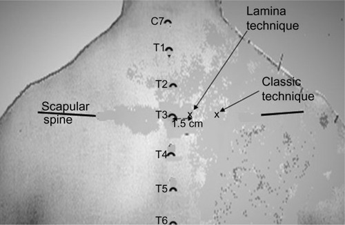 Figure 1 Illustration of the landmarks showing the scapular spine and C7–T6 spinous processes.