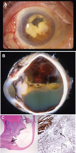 Figure 1 (A) Slit lamp photograph of case 1 at presentation displaying fungal masses in the anterior chamber, representing a large Aspergillus infiltrate. (B) Gross examination of the globe in case 1 discloses a funnel-shaped retinal detachment, a vitreous cavity full of silicone oil, a closed anterior chamber with a dense cyclitic membrane, and a white fibrous plaque on the anterior and posterior surface of the iris. (C) Left image shows low magnification histopathology of the anterior segment of case 1, and is magnified on the right image.