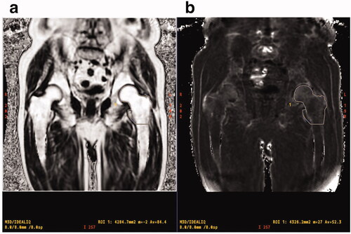 Figure 1. MR images show PDFF (a) and R2* (b) of proximal femur measured in a 76-year-old man with prostate cancer. ROI is manually traced from the femoral head to the horizontal line of the lower end of the lesser trochanter to calculate R2* value and PDFF. PDFF: proton density fat fraction; ROI: region of interest.