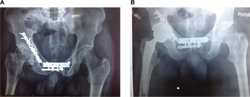 Figure 1 (A) Radiographs of a 62-year-old man who sustained a complex posterior wall acetabular fracture and had ORIF with a reconstruction plate and a DCP. (B) Conversion to THR after posttraumatic arthritis after 5 years of internal fixation.