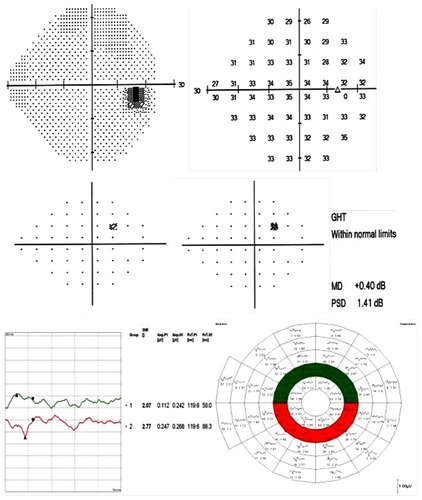 Figure 9 An example of possible early detection of a visual field defect using the SITA standard 24-2 test and the mfVEP hemi-ring comparison analysis in a glaucoma suspect.
