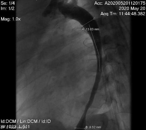 Figure 8 Aortic angiography after 6 months undergoing percutaneous transluminal angioplasty.
