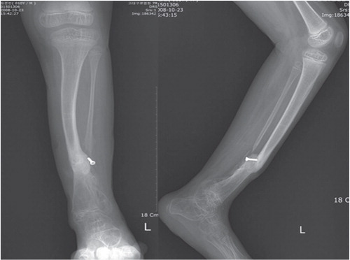 B. Anteroposterior and lateral radiograph of the same patient who was operated elsewhere with attempted four-in-one fusion. At presentation, the child had minimal discharge of pus over the lateral fibular non-union, and had abnormal mobility at the distal third of the tibia. [OK???] Radiographs showed persistent non-union and 40° valgus deformity.
