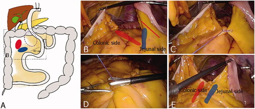 Figure 1. Steps of the Mefix procedure. (A) Schematic diagram of Petersen’s space (purple dotted line), jejunal mesentery (blue area, jejunal side, at site 30 cm distal J-J) with transverse mesocolon (red area, colonic side). (B) Exposure of the suture area jejunal side & colonic side (red line, SMA vascular arcade) (Step 1). (C) Step 2. The suture started between jejunal side just below of SMA vascular arcade and colonic side. (D,E) Step 3. To anchor the mesentery, two-point backward sutures were performed, and Mefix was done.