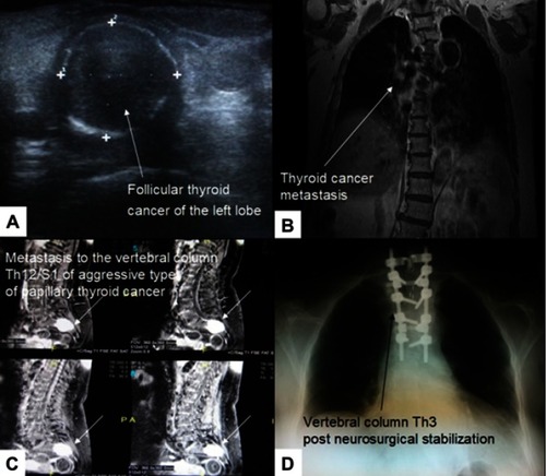 Figure 2 (A) 69-year-old woman with a small follicular thyroid cancer localized in the left lobe. (B) Follicular thyroid cancer metastasis to Th3 of the vertebral column. (C) Aggressive type of the classical type of papillary thyroid cancer metastasis to S1 manifesting severe back pain several months before proper diagnosis in a 61-year-old female. (D) Th3 corporectomy and transpedicular stabilization of Th2 and Th4-Th6.