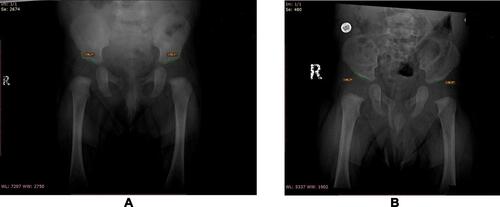 Figure 2 Examples of subjectively described flat and sharp hips. We named the line parallel with the lateral aspect of the region of the inferior iliac spines the Miral line. Iliac Promontory Angle (IPA) is an angle between the Miral Line and a line parallel to the acetabular roof (Acetabular Roof Line). (A) IPA for the both hips in a female infant aged 3 months. This hip was described as sharp by both radiologists. (B) IPA for the both hips in a male infant aged 3 months. This hip was described as flat by both radiologists.