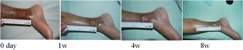 Figure 1. Liu Hua, female, 71 years old, suffered from skin ulceration of the right ankle with infection. The infection was recurrent and uncured for more than 1 month and recovered after 8 weeks of ADSC treatment.