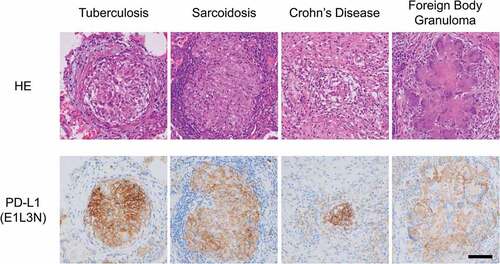 Figure 1. High levels of PD-L1 are expressed in epithelioid granulomatous lesions in tuberculosis, sarcoidosis, Crohn’s disease, and foreign body granuloma. Immunohistochemical staining for PD-L1 was performed using clone E1L3N (Cell signaling technology, Danvers, MA). Bar = 100 μm