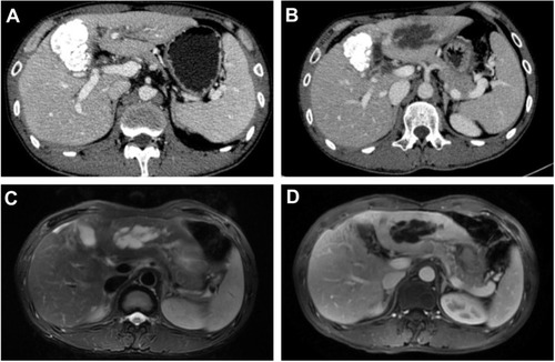 Figure 3 A 44-year-old man underwent TACE for HCC (the 5th patient). (A) One month after TACE, enhanced-CT depicted mild dilatation of left intrahepatic bile duct and visible iodized oil deposition in the quadrate lobe. (B) 3 months after TACE, enhanced-CT demonstrated a round low density with no apparent enhancement in the left hepatic lobe, which was typical for a biloma formation. (C) Follow-up MRI T2WI denoted an ovoid high signal intensity lesion that was similar to the bile duct signal intensity in the same site. (D) Contrast enhanced MRI-T1WI revealed no apparent enhancement and the patient remained clinically asymptomatic.