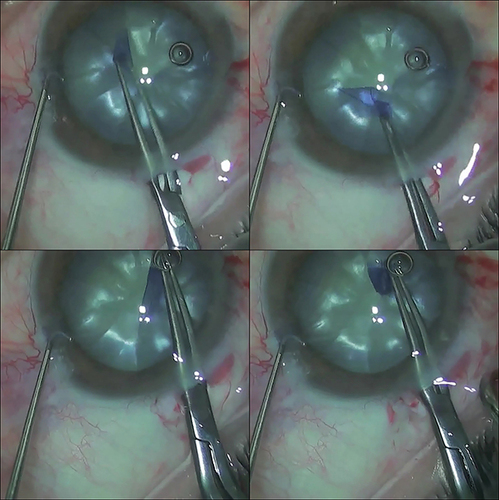 Figure 3 Successful capsulorhexis, circular and continuous.