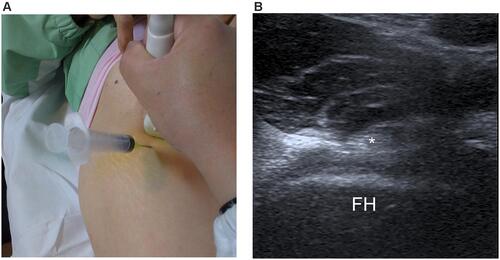 Figure 1 (A) The position of transducer and needle for iliopsoas injection. (B) Anterior view of the hip joint with iliopsoas tendon indicated by the asterisk.