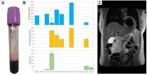 Figure 1 Laboratory and imaging findings. (A) Creamy supernatant from drawn blood. (B) Progression of serum concentrations over time for TG, total cholesterol and lipase. Star (*) specifies heparin infusion and error bars represent interquartile range (TG n=6, lipase n=2). (C) Coronal MRI showing acute pancreatitis. Arrows designate inflammatory plastron.