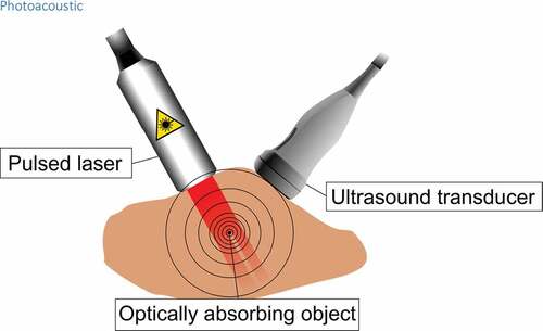 Figure 9. A pulsed laser light travels through tissue in which optically absorbing substance, such as hemoglobin absorbs the energy of the light. This makes the temperature of the object rise rapidly and the object experiences a thermoelastic expansion. This in turn creates a shockwave which travels through the tissue and can be detected at the surface with a piezoelectric sensor such as in an ultrasound transducer