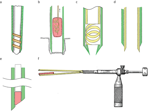 Figure 4. Bone biopsy devices comprising an outer cannula (green) an additional (inner) structure (yellow) and additional characteristics (orange) to retain the biopsy. (a) A bone biopsy device with a threaded section to create a shape lock between the biopsy and the cannula, figure adapted from [Citation38]. (b) A biopsy device with a corkscrew inner structure to create a shape lock to retain the biopsy, figure adapted from [Citation43]. (c) A bone biopsy device with a spring that can compress the biopsy to retain it figure adapted from [Citation61]. (d) A bone biopsy device with a tapered inner structure to compress the biopsy for successful retainment, figure adapted from [Citation45]. (e) A bone biopsy device that retains the biopsy by a sudden change in lumen diameter, figure adapted from [Citation24]. (f) A bone biopsy device that compresses the biopsy and allows for easy removal from the inner structure, figure adapted from [Citation30].