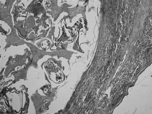 Figure 2. Histologic section through a parasitophorous cyst caused by mites H. nidulans. A thick wall of cysts lined by keratinizing stratified squamous epithelium, parasites and tissue debris are seen. (Photographed by V. Tukač.)