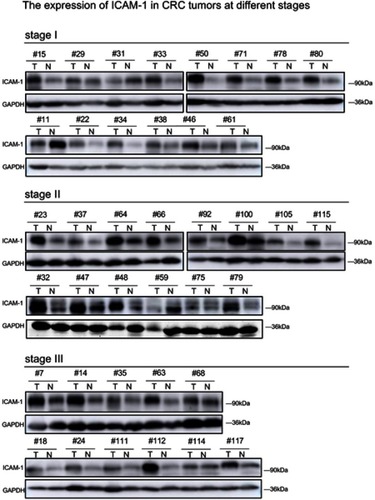 Figure S2 The expression of ICAM-1 in CRC tumors at different stages.Abbreviations: ICAM-1, intercellular adhesion molecule-1; CRC, colorectal cancer.