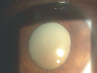 Figure 1 Hypermature cataractous lens.