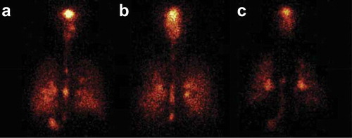 Figure 3. Posterior scintigraphic images from a healthy individual (a), and from individuals with asthma (b) and chronic obstructive pulmonary disease (c), after administration of 99mTc-labeled fluticasone propionate/formoterol fumarate by a breath-triggered inhaler (k-haler®) [Citation48]. (‘Reprinted from Respiratory Medicine, Vol 138, Dominik Kappeler, Knut Sommerer, Claudius Kietzig, Bärbel Huber, Jo Woodward, Mark Lomax, Prashant Dalvi, Pulmonary deposition of fluticasone propionate/formoterol in healthy volunteers, asthmatics and COPD patients with a novel breath-triggered inhaler, with permission from Elsevier.’). Tc, technetium.