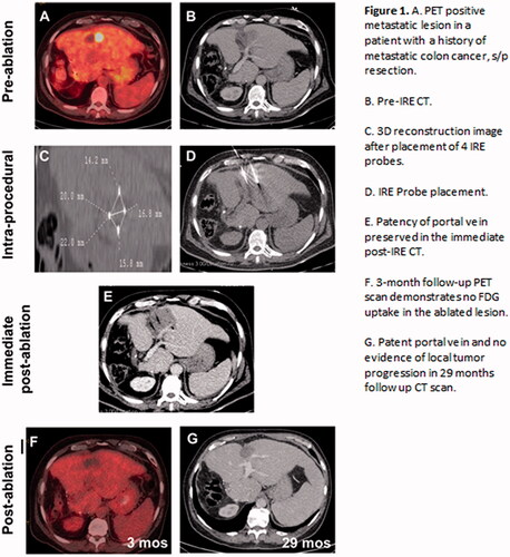 Figure 1. (A). PET positive metastatic lesion in a patient with a history of metastatic colon cancer, s/p resection. (B) Pre-IRE CT. (C) 3D reconstruction image after placement of 4 IRE probes. (D) IRE Probe placement. (E) Patency of portal vein preserved in the immediate post-IRE CT. (F) 3-month follow-up PET scan demonstrates no FDG uptake in the ablated lesion. (G) Patent portal vein and no evidence of local tumor progression in 29 months follow up CT scan.