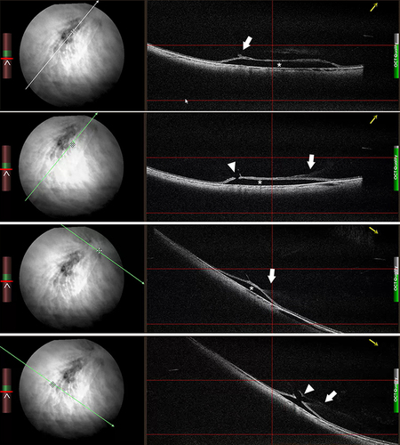 Figure 5 Live optical coherence tomography in lattice degeneration. A series of snapshots showing of characteristic findings of lattice degeneration including retinal detachment (asterisk), retinal hole (arrowhead), and vitreous traction (arrow) in different positions of cross-sectional scans.