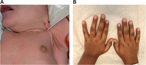 Figure 1 Skin hyperpigmentation in primary adrenal insufficiency. (A) Hyperpigmentation at axillary and nipples in a 10-day-old male infant with salt-wasting congenital adrenal hyperplasia due to 21-hydroxylase deficiency. (B) Skin hyperpigmentation in a 10-year-old Caucasian male with autoimmune adrenalitis (Addison’s disease).