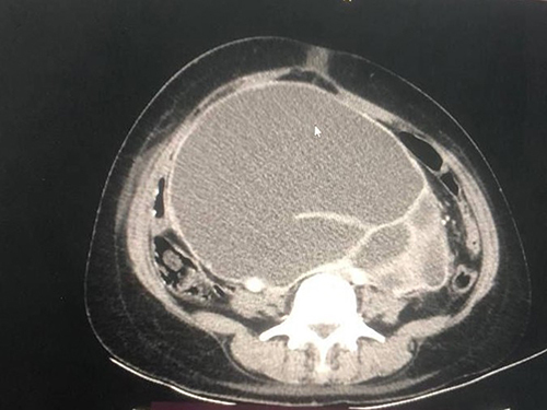 Figure 2 Axial CT scan image of the giant ectopic hydronephrotic right kidney.