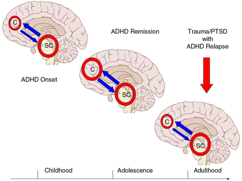 Fig. 1 Model for the effects of trauma on cortical–subcortical functions and possible relapse of ADHD in adults with PTSD.Abbreviations: C=cortical; SC=subcortical.The figure shows hyperactive SC brain regions in childhood (i.e., ADHD onset) with subsequent compensation of C brain regions during adolescence that may be associated with remission of ADHD symptoms. In the event of military-/combat-related trauma and possible PTSD in adulthood, the compensatory effects of C brain regions might be reversed/compromised and ADHD symptoms may relapse.