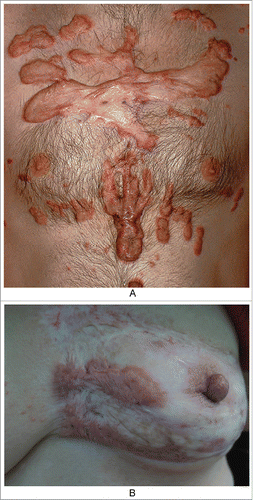 Figure 1. the nature history of keloid. A. From outside to inside: the bright red uplift patches/nodules, growing rapidly; inner ring static relatively,with dark color; then the middle shows atrophy.(from Bolognia JL,Jorizzo JL,Schaffer JV .Dermatology (3rd Edition). Amsterdam(NL):Elsevier;2012.p1622.Fig.98.2B) B. The atrophic scar in the breast with the re-proliferation at the edge.