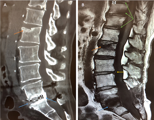 Figure 1 Lumbar spine imaging examination results revealed lumbar spine degeneration.