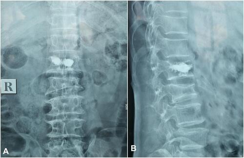 Figure 3 No intraspinal cement leakage was obvious on the anteroposterior (A) and lateral (B) view of the postoperative lumbar radiograph.