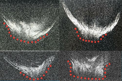 Figure 10 Four ASOCT images of posterior polar cataracts showing a definite dearth in posterior capsular continuity with active herniation of cortical matter into anterior vitreous (red dots). The consistent nipple-shaped configuration in these four images simulates a conical appearance (hence the conical sign) suggestive of posterior capsular deficiency.