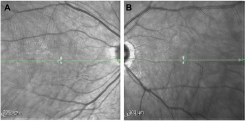 Figure 3 The merged infrared images obtained from preopened and closed MH of both cases: (A) Case 1 and (B) Case 2.