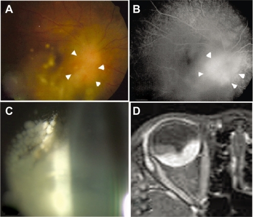 Figure 1 Fundus photograph (A), fluorescein angiography (B), slit-lamp biomicroscopy (C), and gadolinium-enhanced T1-weighted MRI of the right eye (D). A) The fundus was blurred due to the dense vitreous opacity. The optic disc was swollen, and there was an elevated orange-colored subretinal lesion situated adjacent to the optic disc (arrowhead). B) Hyperfluorescence in the initial phase (arrowhead) in the orange-colored subretinal lesion and optic disc. C) Whitish dense anterior vitreous opacity. D) A markedly enhanced appearance underlying the posterior retina.