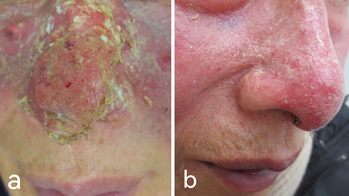 Figure 1 (a) Papules and pustules with an erythematous base on the nose. (b) After treatment.