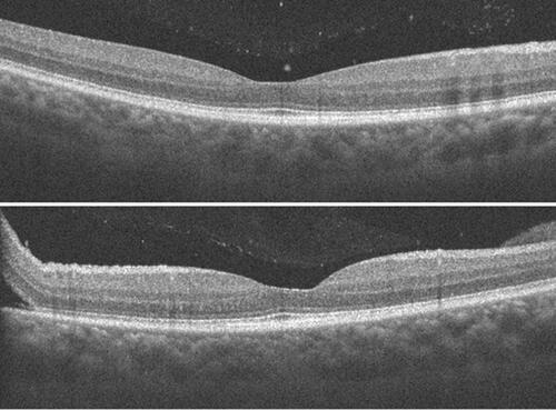 Figure 7 Superior macular “on” retinal detachment with attached macula and attached vitreous.