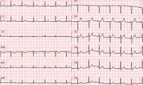 Figure 3. Normal ECG after placement of the chest tube.