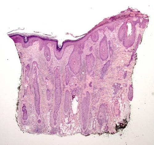 Figure 8 Early stage of erosive pustular dermatosis of the scalp: pathology shows laminated orthokeratosis and psoriasiform hyperplasia at the epidermis; slight mixed inflammatory infiltrate mainly consisting of neutrophils, lymphocytes, and plasmocytes, and mild fibrosis at the papillary dermis; hair follicular density is normal, with terminal, miniaturized anagen follicles and an increased number of catagen follicles.