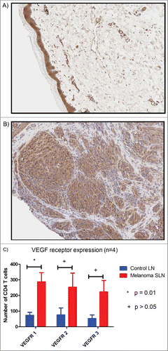 Figure 4. Representative immunohistochemistry slides (5x) stained with anti-VEGF antibody from (A) benign nevi with no VEGF staining and (B) melanoma with diffuse cytoplasmic staining. (C) Histogram comparing VEGF receptor expression within melanoma SLN and control lymph nodes.