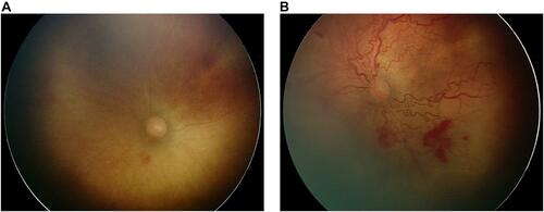 Figure 1 (A) Pre-APROP (early APROP) areas of avascular retina in zone 1 and subtle changes at the vascular–avascular junction with a small annular hemorrhage. (B) Rapid progression to APROP with plus disease and hemorrhages.