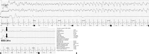 Figure 1 An inadequate response in the ninth session (bilateral brief pulse ECT, Low 0.5, 100%), in which no motor seizure was observed, and the peak heart rate did not increase from the baseline.