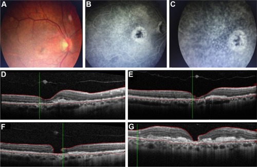 Figure 1 66-old-male patient with age-related macular degeneration, who developed full thickness macular hole after ranibizumab injections.Notes: (A) Color fundus photo in a 66-year-old male patient, demonstrating a pigment epithelium detachment at the fovea surrounded by drusen and few retinal haemorrhages in his right eye; (B) early-phase and (C) late-phase fluorescein angiography of the same patient, showing an active choroidal neovascularization; (D) optical coherence tomography, showing subretinal fluid, pigment epithelium detachment, and retinal pigment epithelium changes, as well as disruption in ellipsoid zone; (E) optical coherence tomography after two ranibizumab injection, showing regression of subretinal fluid; (F) optical coherence tomography 2 months after the last ranibizumab injection, showing full-thickness macular hole; (G) optical coherence tomography 4 months later, showing the development of disciform scar underneath the macular hole, extending beyond the hole’s edges.