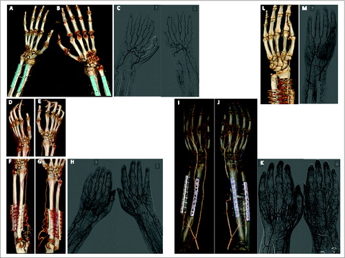 Figure 2. 3D-reconstructions of CT-angiography and conventional angiography (A–C) patient #1; (D–H) patient #2; (I–K) patient #3; (L and M) patient #4.